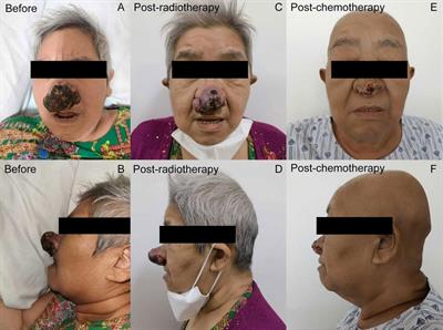 Metastasis of ovarian cancer to nasal skin and skin on the trunk: a rare case report